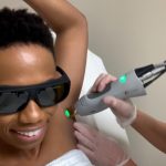 Milan-Laser-Hair-Removal_Underarm-treatment-1